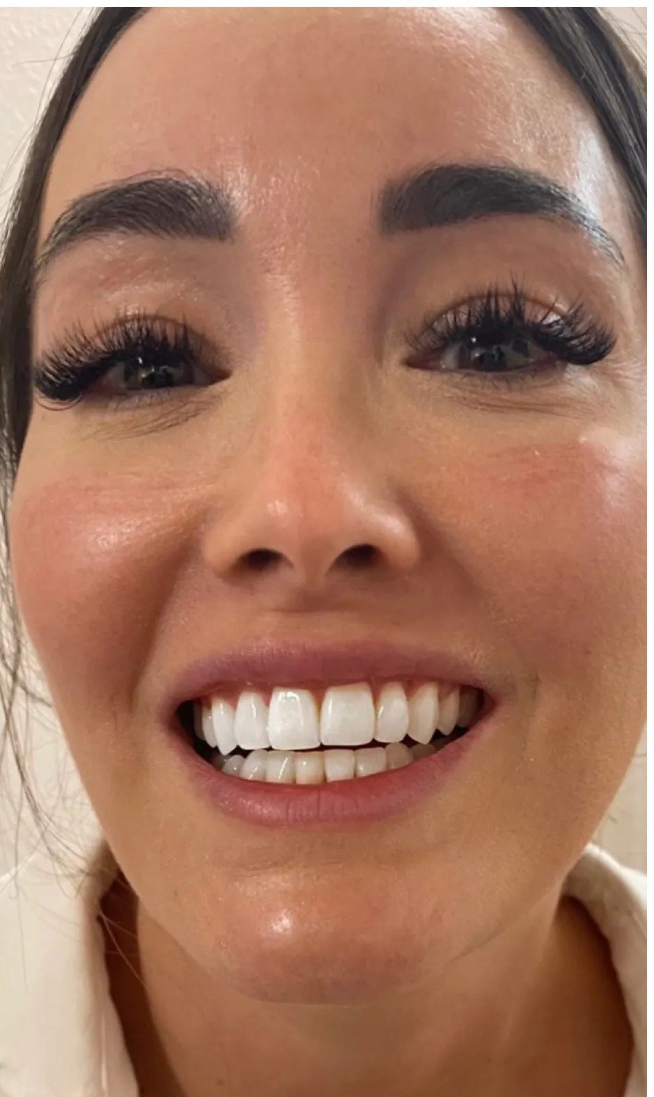Patient smile after whitening