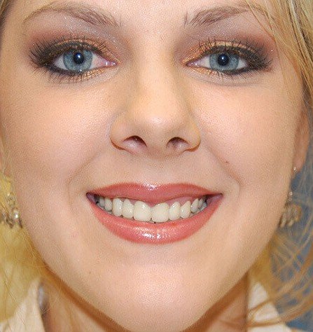 Patient smile after treatment