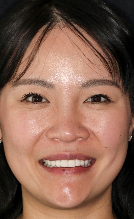 Patient smile after veneers