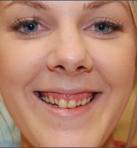 Patient smile before treatment