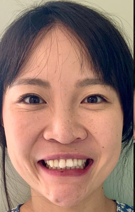 Patient smile before veneers