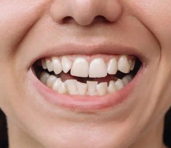 Patient smile before Invisalign