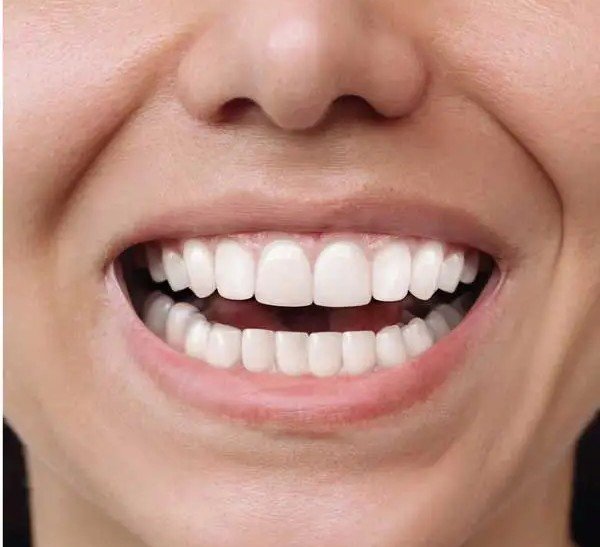Patient smile after Invisalign