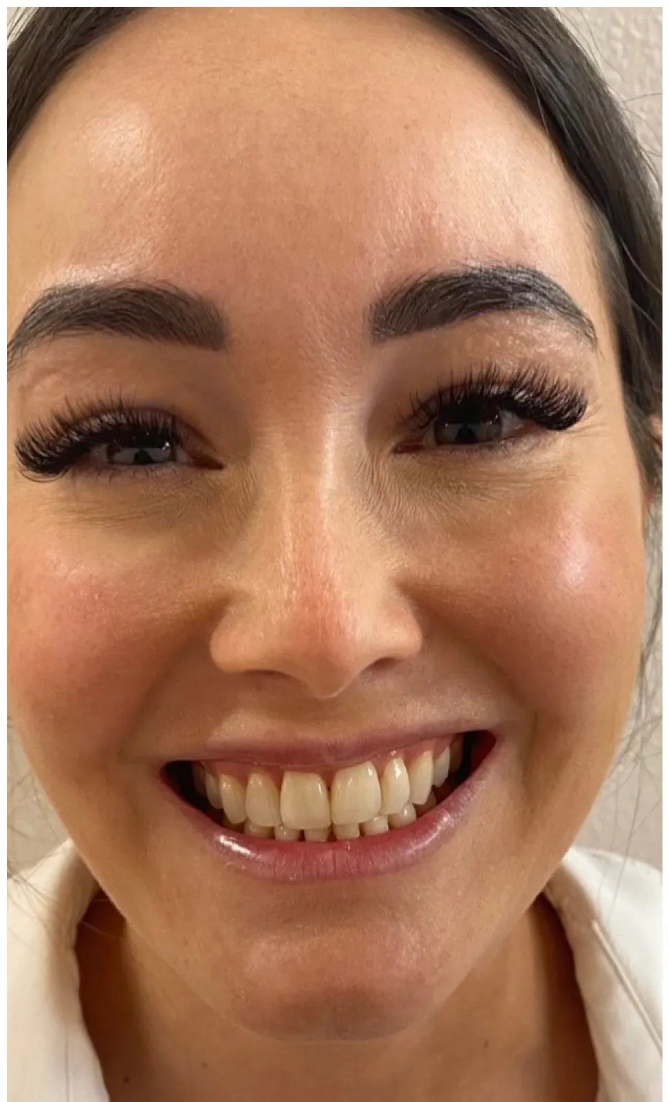 Patient smile before whitening