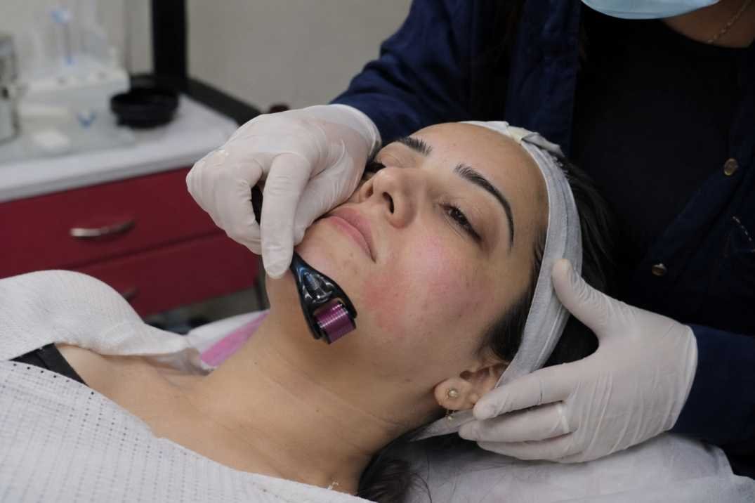 Derma Roller