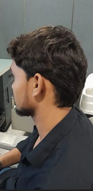 Hair Transplant after
