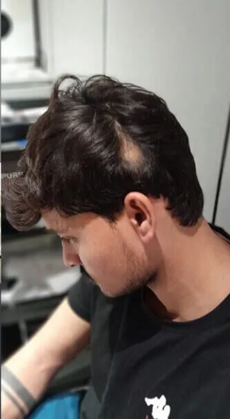 Hair Transplant before