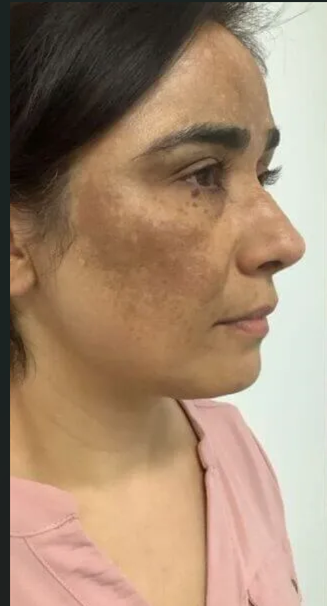 Pigmentation Treatment before