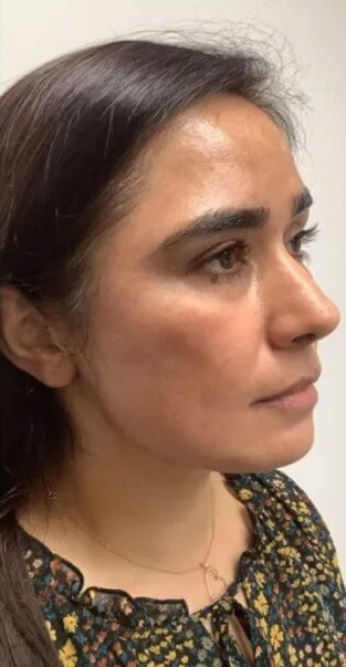 Pigmentation Treatment after