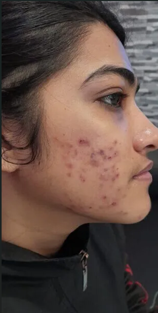 Acne Treatment before