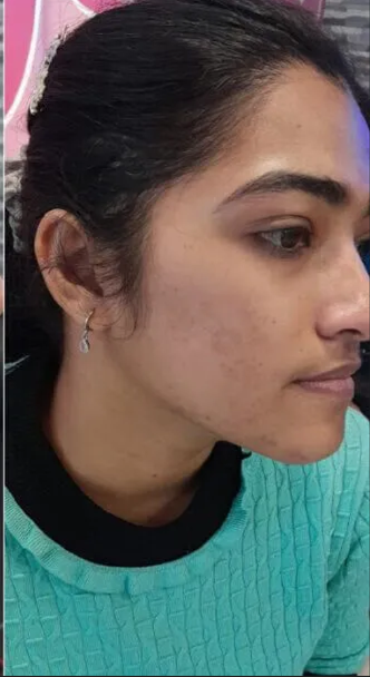 Acne Treatment after
