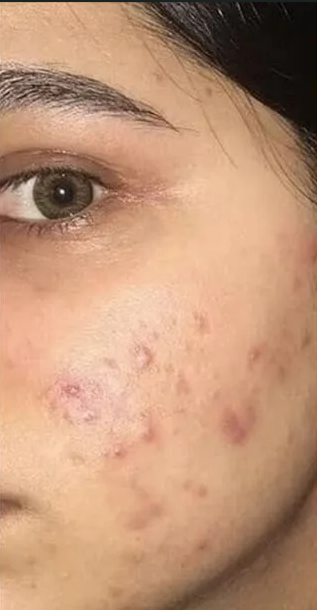 Before treatment