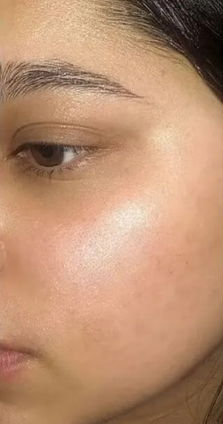 After treatment